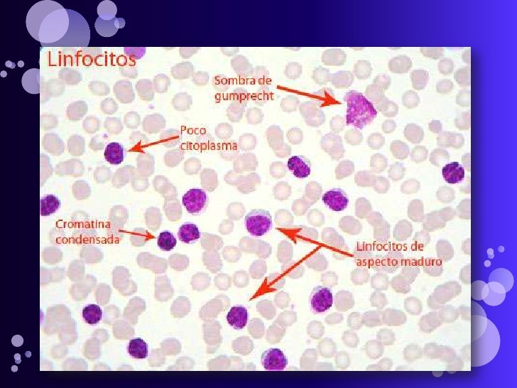 Leucemia linfatica cronica