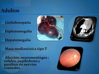 Adultos

Linfadenopatia
Esplenomegalia
Hepatomegalia
Masa mediastinica tipo T
Afección neuromeningea :
 cefalea, papiledema y
 parálisis de nervios
 craneales.
 