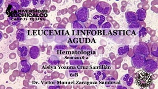 LEUCEMIA LINFOBLASTICA
AGUDA
Hematología
Sem 2018-2
Aislyn Yoanna Cruz Santillán
Dr. Víctor Manuel Zaragoza Sandoval
6•B
 