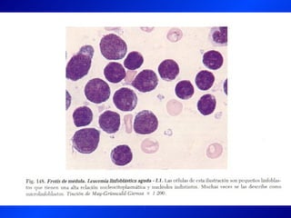 Leucemia Linfocitica Cronica B