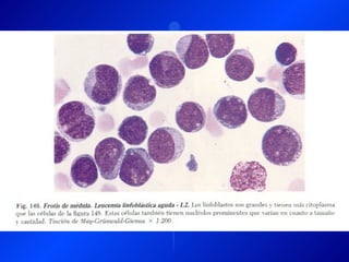 Leucemia Linfocitica Cronica B