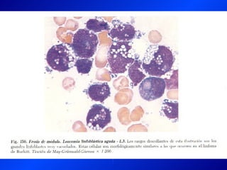 Leucemia Linfocitica Cronica B