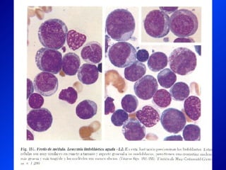 Leucemia Linfocitica Cronica B