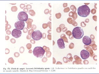 Leucemia Linfocitica Cronica B