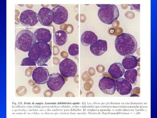 Leucemia Linfocitica Cronica B