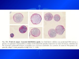 Leucemia Linfocitica Cronica B