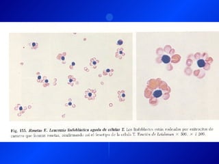 Leucemia Linfocitica Cronica B