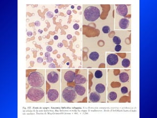 Leucemia Linfocitica Cronica B