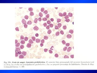 Leucemia Linfocitica Cronica B