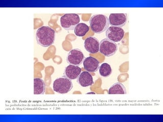 Leucemia Linfocitica Cronica B