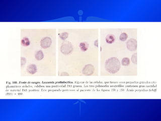Leucemia Linfocitica Cronica B