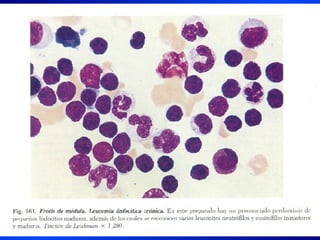 Leucemia Linfocitica Cronica B