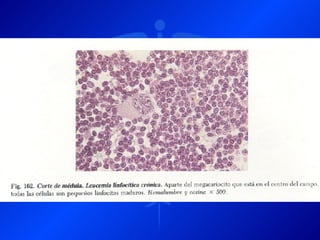 Leucemia Linfocitica Cronica B