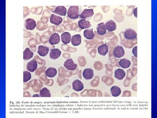 Leucemia Linfocitica Cronica B