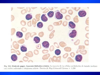 Leucemia Linfocitica Cronica B