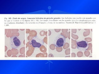 Leucemia Linfocitica Cronica B
