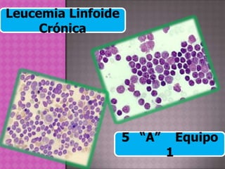 Leucemia Linfoide
     Crónica




                    5 “A”       Equipo
                            1
 