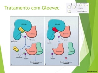 Tratamento com Gleevec
João Marcos
 