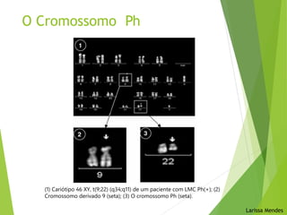 O Cromossomo Ph
(1) Cariótipo 46 XY, t(9;22) (q34;q11) de um paciente com LMC Ph(+); (2)
Cromossomo derivado 9 (seta); (3) O cromossomo Ph (seta).
Larissa Mendes
 