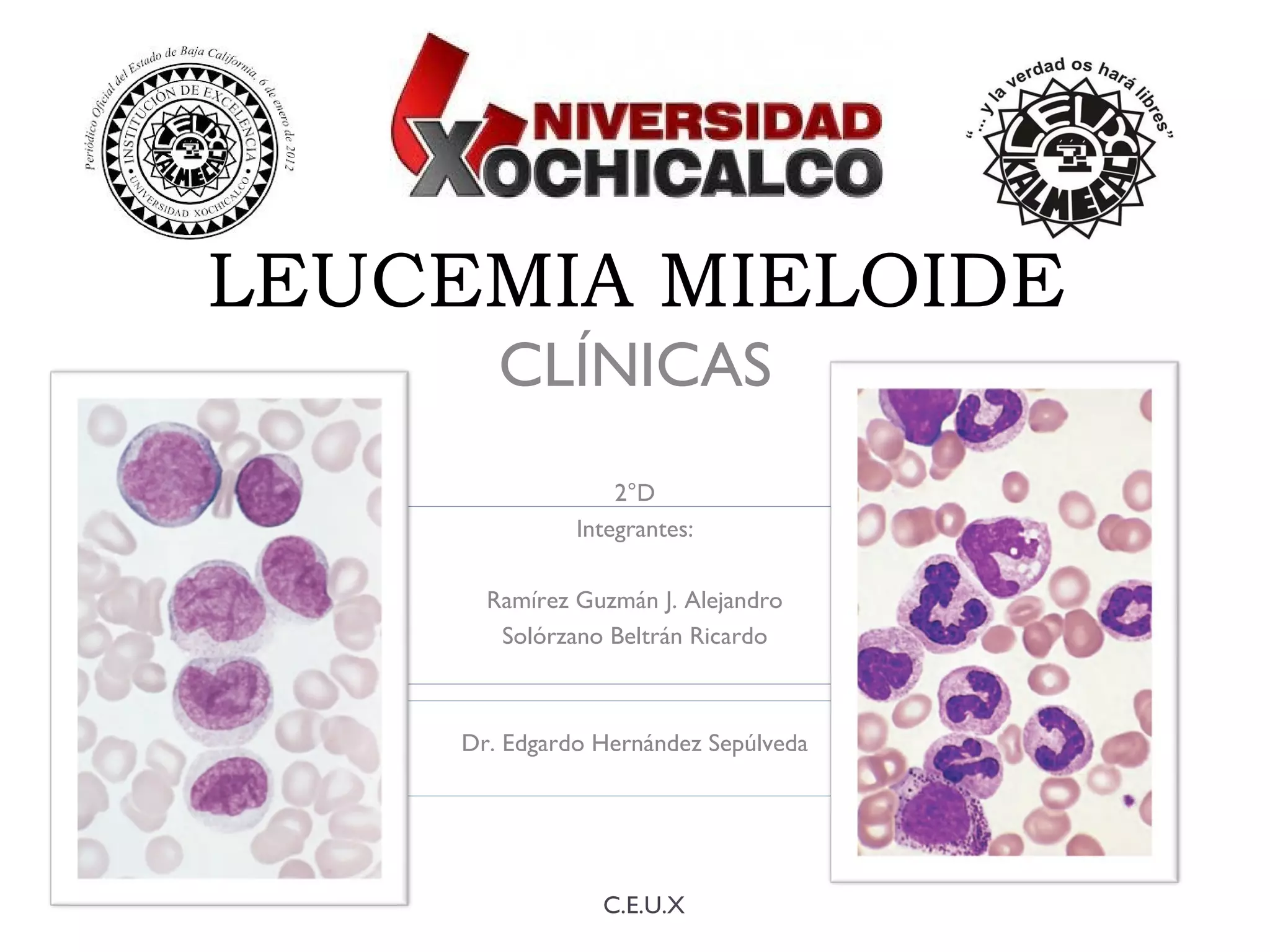 Leucemia mieloide: síntomas, diagnóstico y tratamiento | PPT