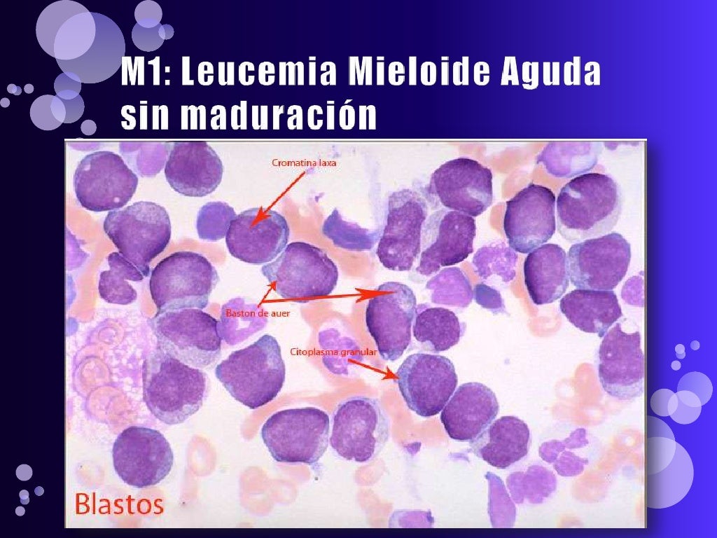 Leucemia mieloide aguda