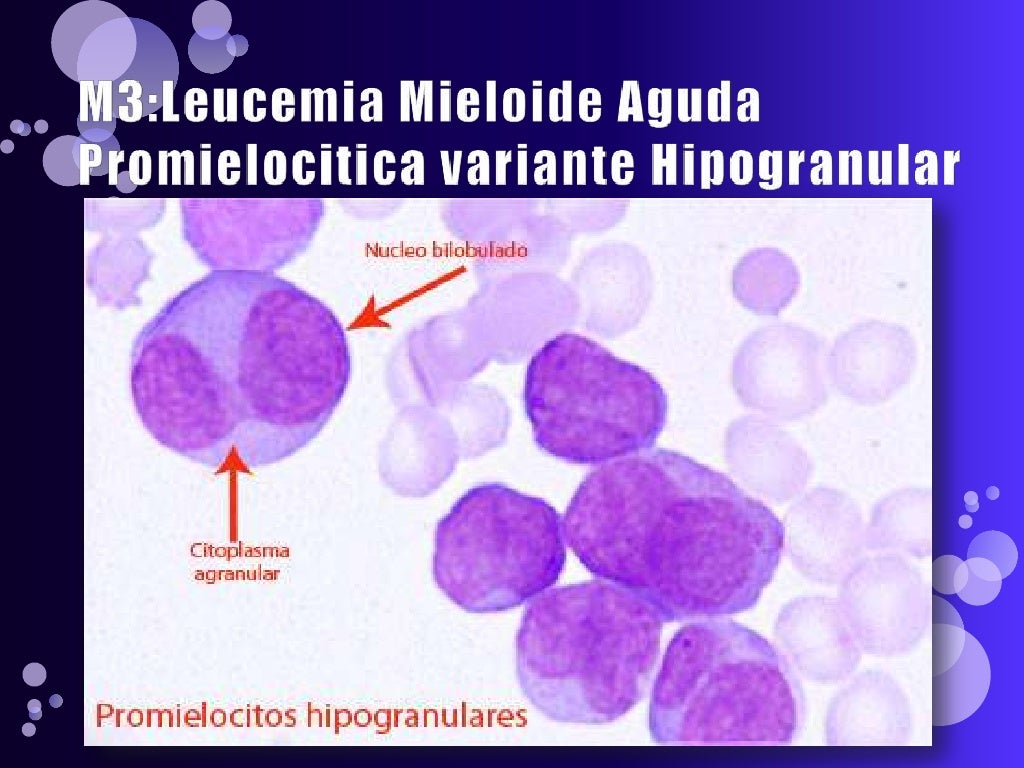 Leucemia mieloide aguda