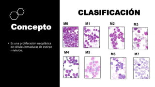 Concepto
• Es una proliferación neoplásica
de células inmaduras de estirpe
mieloide.
CLASIFICACIÓN
 