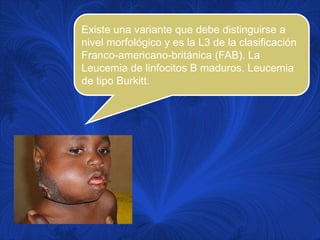 Existe una variante que debe distinguirse a
nivel morfológico y es la L3 de la clasificación
Franco-americano-británica (FAB). La
Leucemia de linfocitos B maduros. Leucemia
de tipo Burkitt.
 
