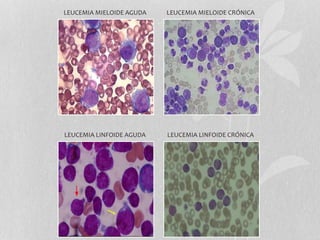 LEUCEMIA MIELOIDE AGUDA LEUCEMIA MIELOIDE CRÓNICA
LEUCEMIA LINFOIDE AGUDA LEUCEMIA LINFOIDE CRÓNICA
 