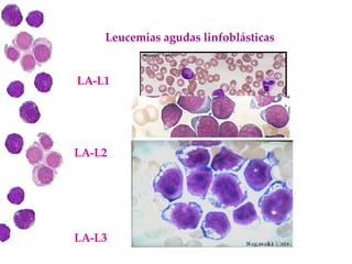 Leucemias agudas linfoblásticas LA-L1 LA-L2 LA-L3 
