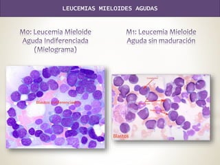 LEUCEMIAS MIELOIDES AGUDAS
 