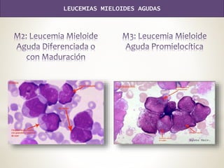 LEUCEMIAS MIELOIDES AGUDAS
 