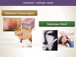Síndrome hemorrágico
Síndrome febril
LEUCEMIAS LINFOIDE AGUDA
 