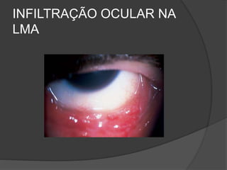 INFILTRAÇÃO OCULAR NA 
LMA 
 