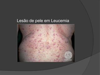 Lesão de pele em Leucemia 
 
