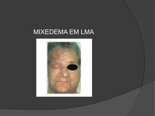 MIXEDEMA EM LMA 
 