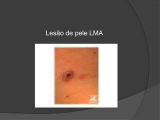 Lesão de pele LMA 
 