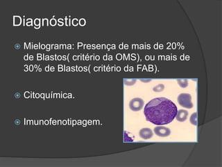 Diagnóstico 
 Mielograma: Presença de mais de 20% 
de Blastos( critério da OMS), ou mais de 
30% de Blastos( critério da FAB). 
 Citoquímica. 
 Imunofenotipagem. 
 