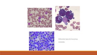 Diferentes tipos de leucemias
mieloides
 