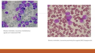 Blastos mieloides, Leucemia mieloblástica
aguda con maduración M2
Blastos mieloides, Leucemia promielocítica aguda (M3) hipogranular
 