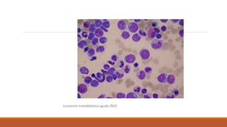Leucemia mieloblástica aguda (M2)
 