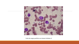 Frotis de sangre periférica con bastos linfoides L2
 