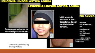 Cortesía Dr. Juan Carlos Ling
Oncólogo Pediatra
 