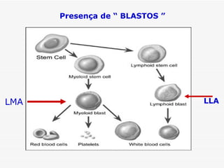 Presença de “ BLASTOS ”




LMA                             LLA
 