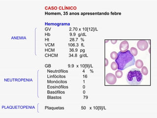 CASO CLÍNICO
                Homem, 35 anos apresentando febre
                 
                Hemograma
                GV            2.70 x 10[12]/L
                Hb            9.9 g/dL
   ANEMIA       Ht            28.7 %
                VCM          106.3 fL
                HCM           36.9 pg
                CHCM          34.8 g/dL
                 
                GB           9.9 x 10[9]/L
                  Neutrófilos        4 %
                  Linfócitos         16
NEUTROPENIA       Monócitos          1
                  Eosinófilos        0
                  Basófilos          0
                  Blastos            79

PLAQUETOPENIA   Plaquetas      50 x 10[9]/L
 