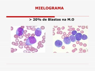 MIELOGRAMA


> 20% de Blastos na M.O
 