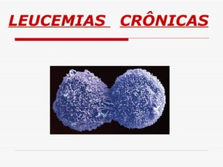 LEUCEMIAS CRÔNICAS
 