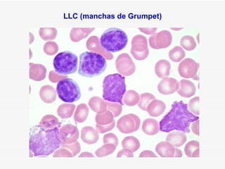 LLC (manchas de Grumpet)
 