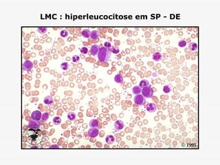 LMC : hiperleucocitose em SP - DE
 