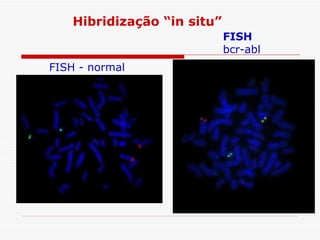 Hibridização “in situ”
                             FISH
                             bcr-abl
FISH - normal
 